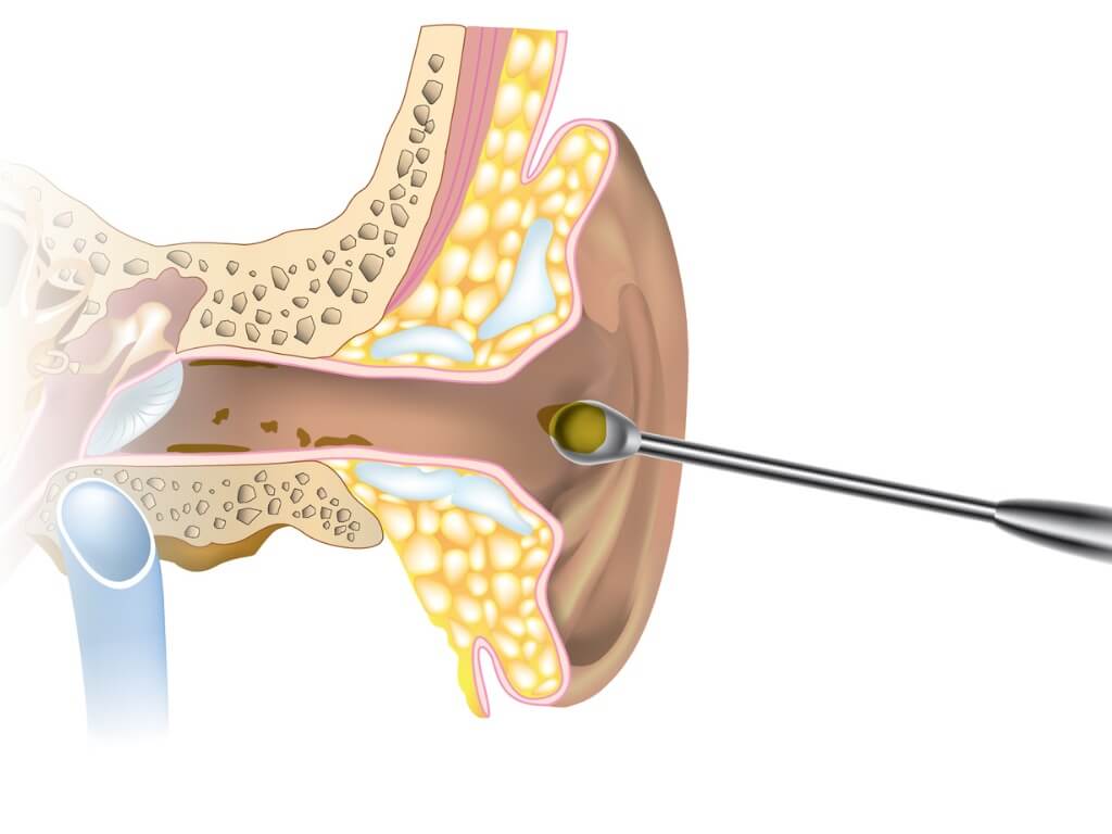 manual extraction