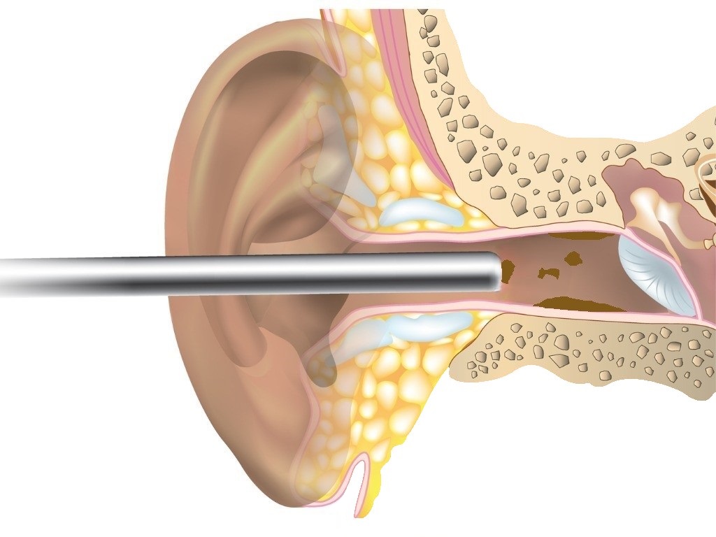 Microsuction